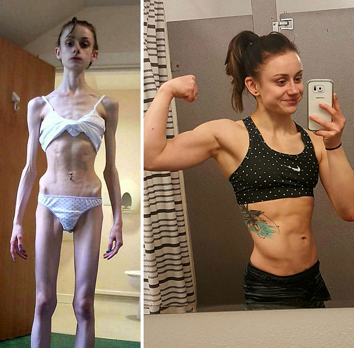 Galéria: Sokkoló majd megnyugtató képek: emberek, akik legyőzték az anorexiát!