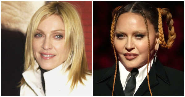 Borítókép: Teljesen felismerhetetlen lett: egy plasztikai sebész elárulta, milyen beavatkozásokon eshetett át Madonna